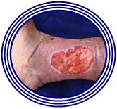 Úlceras Vasculares